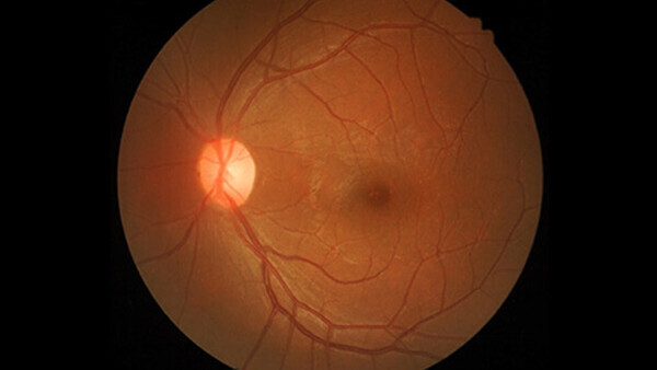 Bild på angiografi av ögat