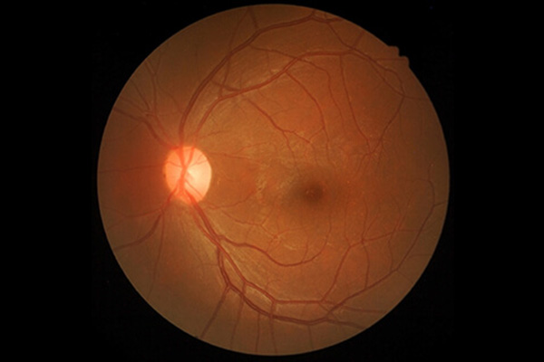 Bild på angiografi av ögat